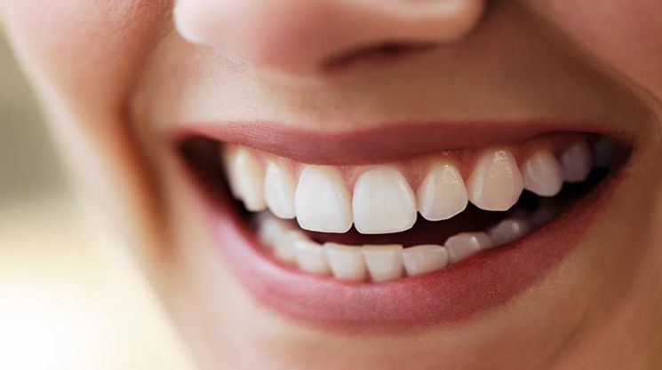 Blanqueamiento dental sin peróxido: ¿funciona y es seguro?